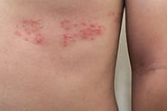 Shingles: A Painful but Preventable Disease
