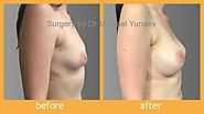 Correcting Tuberous Breasts Will Increase Your Confidence