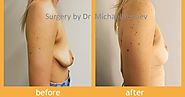 Revert Time On Your Breasts With This Procedure