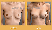 Breast Surgery: Basic Things To Know