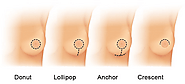 What Is It About Breast Surgery That Makes It Effective? Know The Basic Answers Here