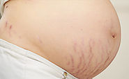 Care of Stretch Marks After Pregnancy - Pregnancy