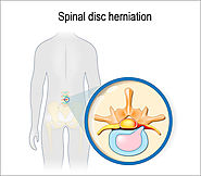 Disk Prolapse Surgery in Chennai | Treatment for Herniated Disc India
