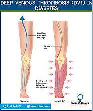 DEEP VENOUS THROMBOSIS (DVT) IN DIABETES | Tips By Diabetic Foot Doctor In Nerul, Navi Mumbai