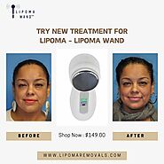 Try New Treatment For Lipoma - Lipoma Wand