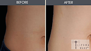 Lipoma Wand Therapy For Lipoma Removal