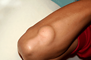 How to Get Lipoma Treatment without Surgery