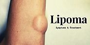 Lipoma – Symptoms of Lipoma and its Natural Treatment