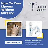 How to Cure Lipoma Without Surgery