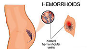 Get bleeding haemorrhoids treatment Cape Town.