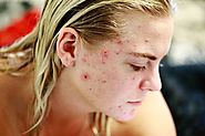 What Cause Acne in Adults » Doctor Shifu » health care