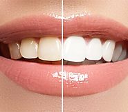 Utilize The Blissful Treatment of Teeth Whitening Melbourne for the Betterment of Yourself