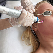 Laser Facial Rejuvenation Treatment | Dermamode