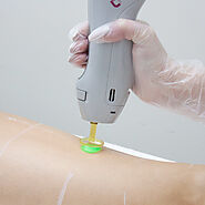 Dermamode | Leading Laser Clinic for Acne Laser Treatment and Laser Hair Removal