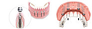 Perfect Dental Implants in Dubai: Cross Roads Dental Clinic