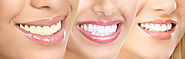 Best Place for Teeth Whitening in Dubai: Cross Roads Dental Clinic