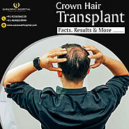 What Should You Know about Crown Hair Loss Treatment in Agra?