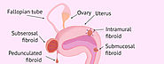 Fibroids Treatment in Hyderabad