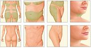 Types Of Liposuction