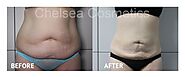 Picosure Laser Pigmentation As A Form Of Liposuction: Major Details To Know