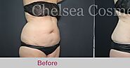 Know The Different Offered Advancements Of Liposuction Surgery: Basic Guide
