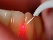 Implant Dentist In ahmedabad