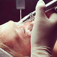 Have you tried Micro-Needling?