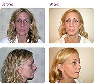 Facelift Surgery Birmingham | Rhytidectomy | Birmingham Beauty Clinic