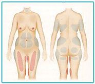 What is Liposuction Surgery and How does it Work?