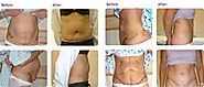 Know more about Tummy Tuck Surgery or Abdominoplasty
