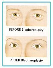 Know more about Blepharoplasty or Eyelid Correction Surgery