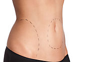 Advanced Liposuction Surgery for Men and Women