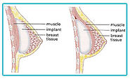 Know More about Breast Augmentation Surgery