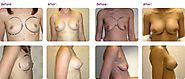 Breast Augmentation Surgery in Birmingham