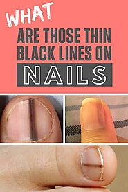 6 Ways to Get Rid of Black Lines on Nails as Fast as Possible