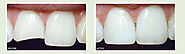 Coral Gables Dentist | Hank Barreto DMD | Gum Recession Treatment