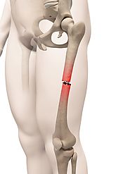 Know About Fracture of the Mid Shaft of Femur