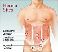 The Best Hernia Surgery In Pune