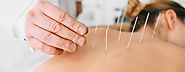 City Acupuncture For Back Pain in New York