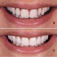 Want to Beam a Perfect Smile Braces can help you out! – Best Cosmetic Dentist in Udaipur