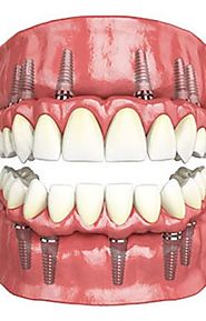 Benefits of Full Mouth Rehabilitation - Wattpad