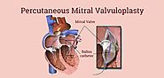 Balloon Mitral Valvuloplasty in India, Mitral Valve Stenosis - Heart Valve Therapy