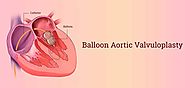 Balloon Aortic Valvuloplasty in India, Mitral Valve Surgery - Heart Valve Therapy