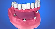 Best Denture Implants in Sydney.