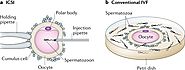 In Vitro Fertilization/Intracytoplasmic Sperm Injection for Male Infertility. – Goral Gandhi – News & Updates