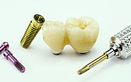 Dental Implants Service at Cheap Rates Than Ever Before