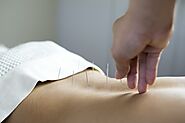 Acupuncture – An Effective Therapy for Pain Treatment and Pain Management - Article