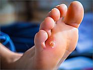 Foot Callus Symptoms, Causes and Treatments | Madurai Footcare Centre