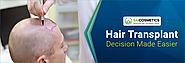 Choose the Best Criteria for Hair Transplant | Sai Cosmetics