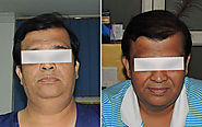 Cosmetic Surgery in Pune by Sai Cosmetics
